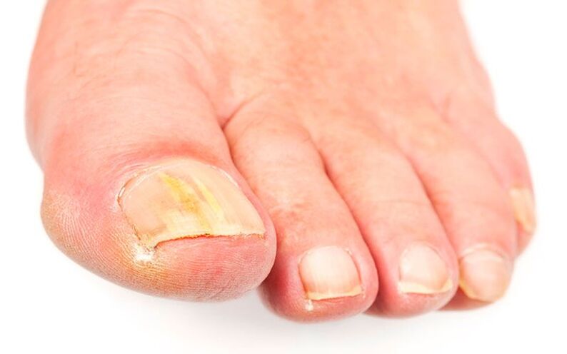 D'Ursaachen vum Pilz