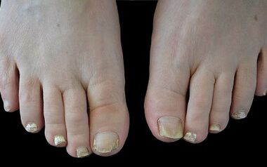 Wéi de Pilz op Äre Fanger lass gëtt