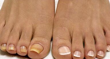 Flott filgus Behandlungsmethoden