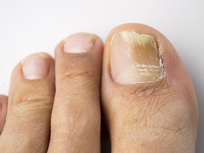 Déi initial Etapp vum Pilz