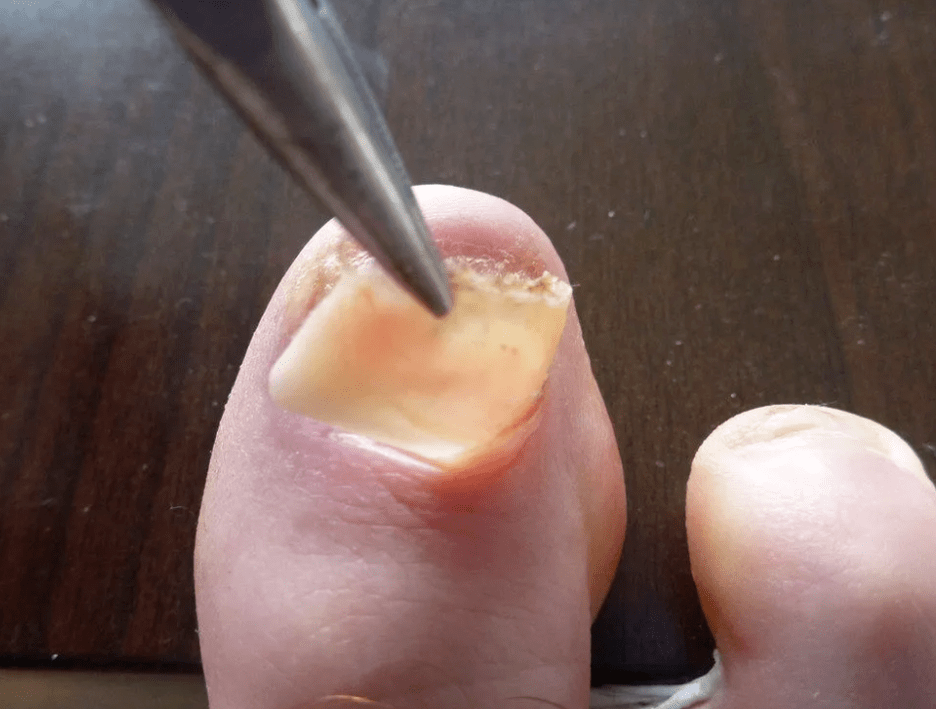 Ewechhuele vun der Plack