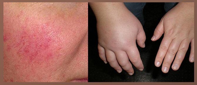 Nebenwirkungen vun Drëpsen